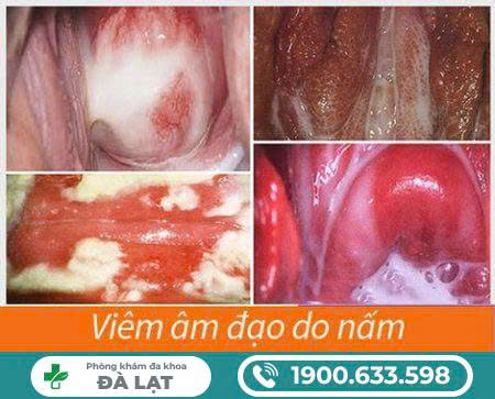 Hình ảnh minh họa